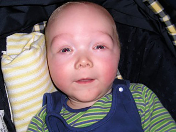 Дцп лицо. Мозговой гигантизм (синдром Сотоса). Синдром Сотоса новорожденный.